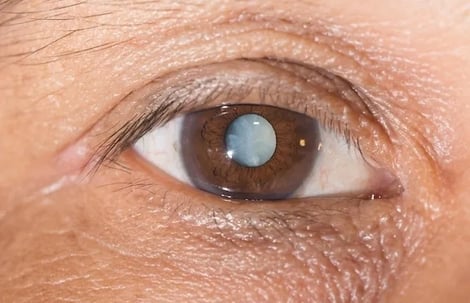 Close de um olho com catarata avançada, evidenciando a opacificação do cristalino