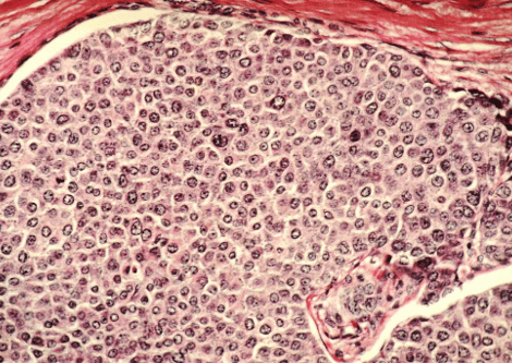 Breast Cancer cells