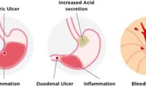 Stomach germ miracle healing of honey Monka honey and fasting (1)