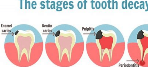 tooth caries