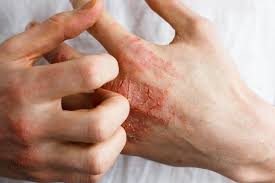 Skin Diseases