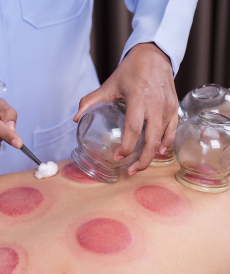 Cupping