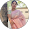 simmy kumari dental patient at Rps Dental Clinic in Ranchi