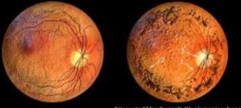 retinitis pigmentosa