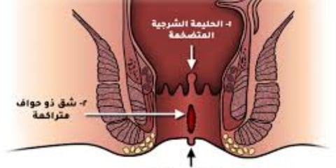 healing processes by reducing inflammation and providing a rest period for the digestive system.