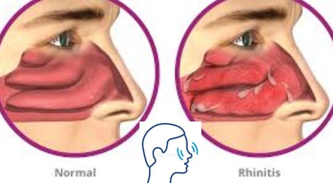 التهاب الحلق وسيلان الأنف والبلغم