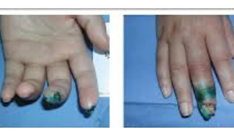 Painful Digital Ulcers : role of Role of Fasting and Cold Water