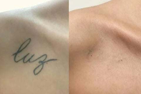 Remoção de Tatuagem