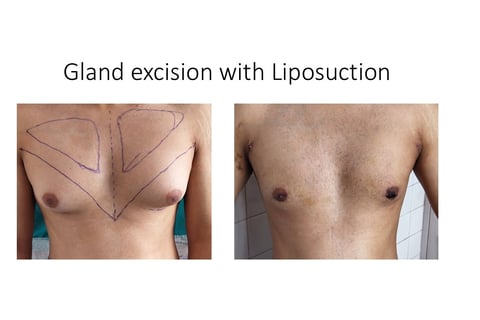 Gyanecomastia surgery Man boob surgery