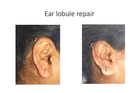 Ear lobule repair with ear piercing