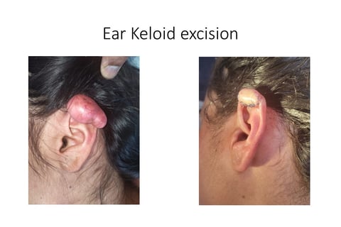 Ear keloid surgery