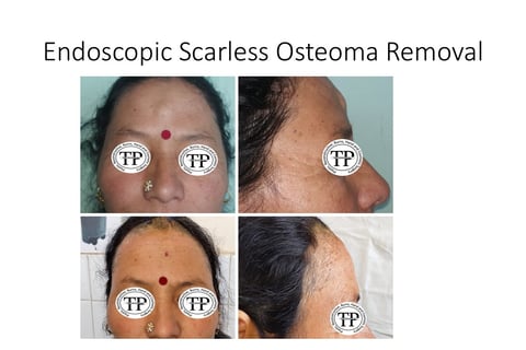 Osteoma endoscopic surgery