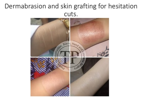 Self harm hesitation cuts