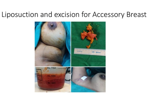 Axillary breast liposuction