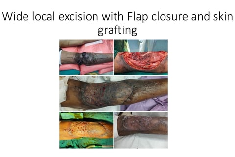 Skin cancer flap skin grafting