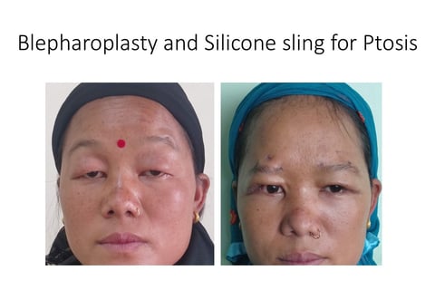 Droopy eyelids Ptosis surgery