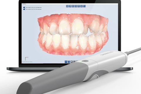 Scanner intraoral moderno oferecendo precisão e conforto superiores