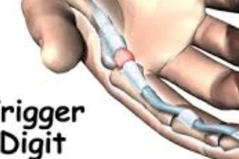 🤲 Trigger Finger & the Role of Voluntary Fasting: A Natural Healing Approach