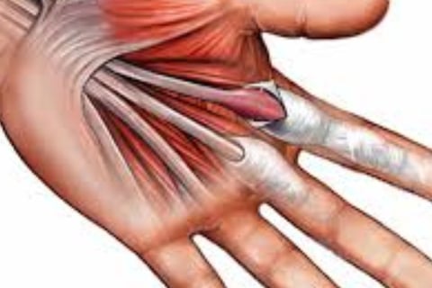 🤲 Trigger Finger & the Role of Voluntary Fasting: A Natural Healing Approach