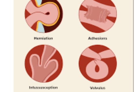 Emesis and Upper Digestive Tract Blockages
