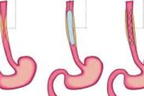 Emesis and Upper Digestive Tract Blockages