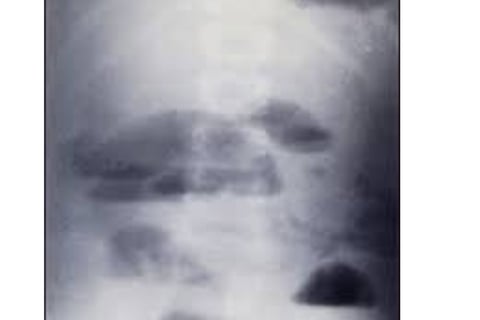 Emesis and Upper Digestive Tract Blockages