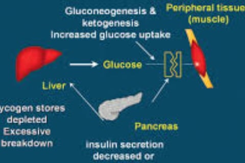Is Fasting Superior to Medication in Diabetes Management?
