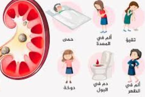 انسداد الحصوة الاعراض