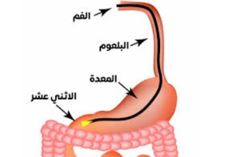 Emesis and Upper Digestive Tract Blockages
