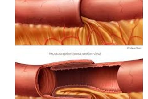 Emesis and Upper Digestive Tract Blockages