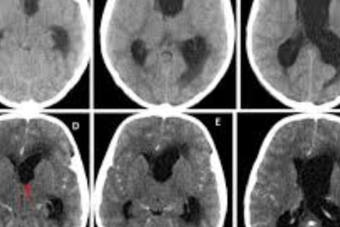 Hydrocephalus   increased CSF in the ventricles (fluid-filled cavities) of the brain by obstruction 