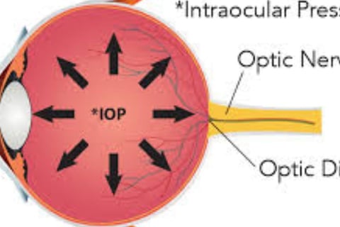 Acute angle-closure glaucoma Severe headache Severe eye pain Nausea or vomiting