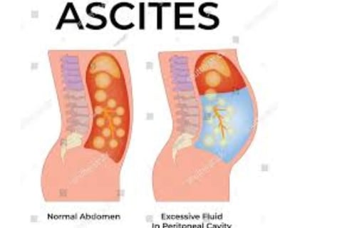 Abdominal Paracentesis ascites