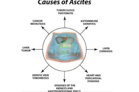 Abdominal Paracentesis causes