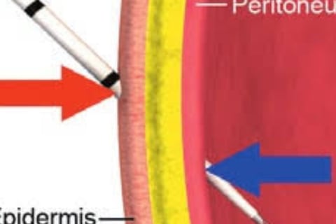 Abdominal Paracentesis Diagnostic and Therapeuti