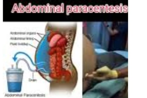 Abdominal Paracentesis Diagnostic and Therapeutic