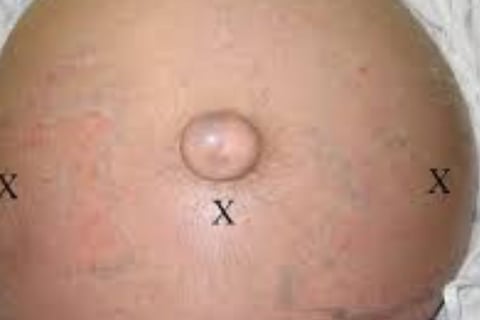 Abdominal Paracentesis Diagnostic and Therapeutic complementary issues (2)