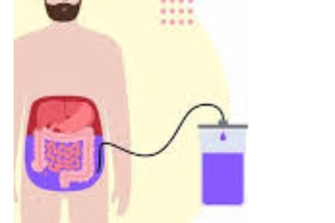 Abdominal Paracentesis Diagnostic and Therapeutic complementary issues