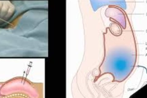 Abdominal Paracentesis Diagnostic and Therapeutic