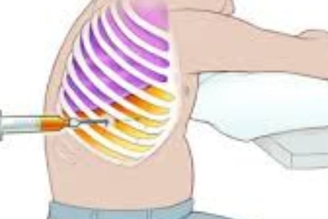 Abdominal Paracentesis Diagnostic thoracentesis