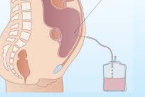Abdominal Paracentesis diagnstic theraputc