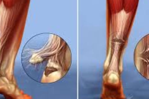 achilles tendon
