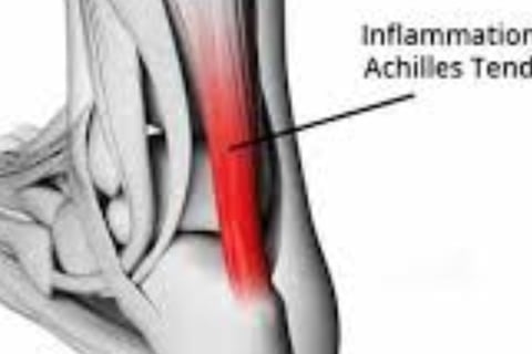 achilles tendon