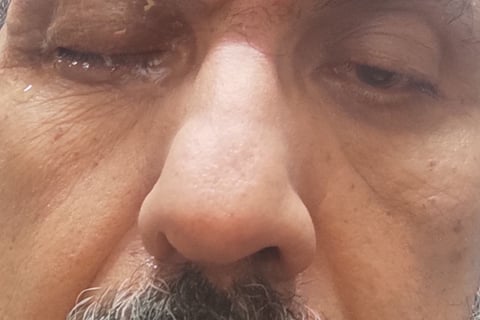 application of honey to eyes