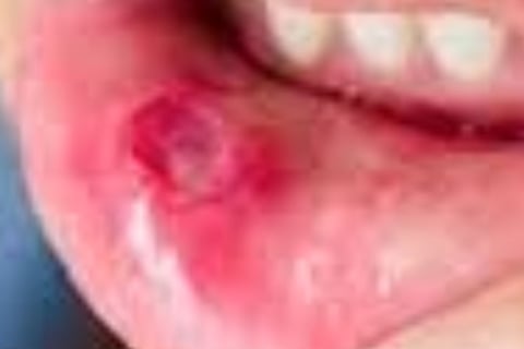 Behcet's Disease : are you using honey