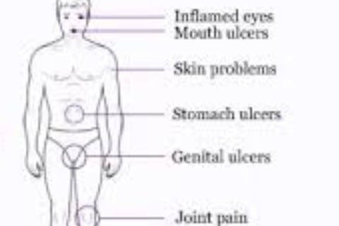 behçet's disease treatment