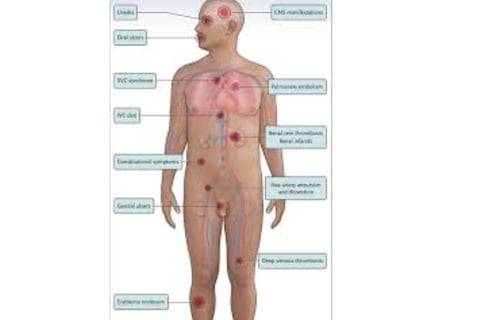 behçet's disease diagnostic criteria