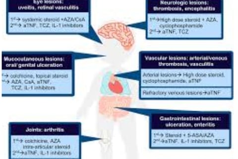 behçet's disease