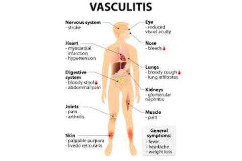 vasculitis