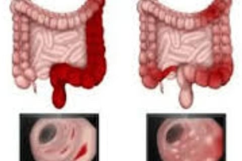 Bleeding Per Anus